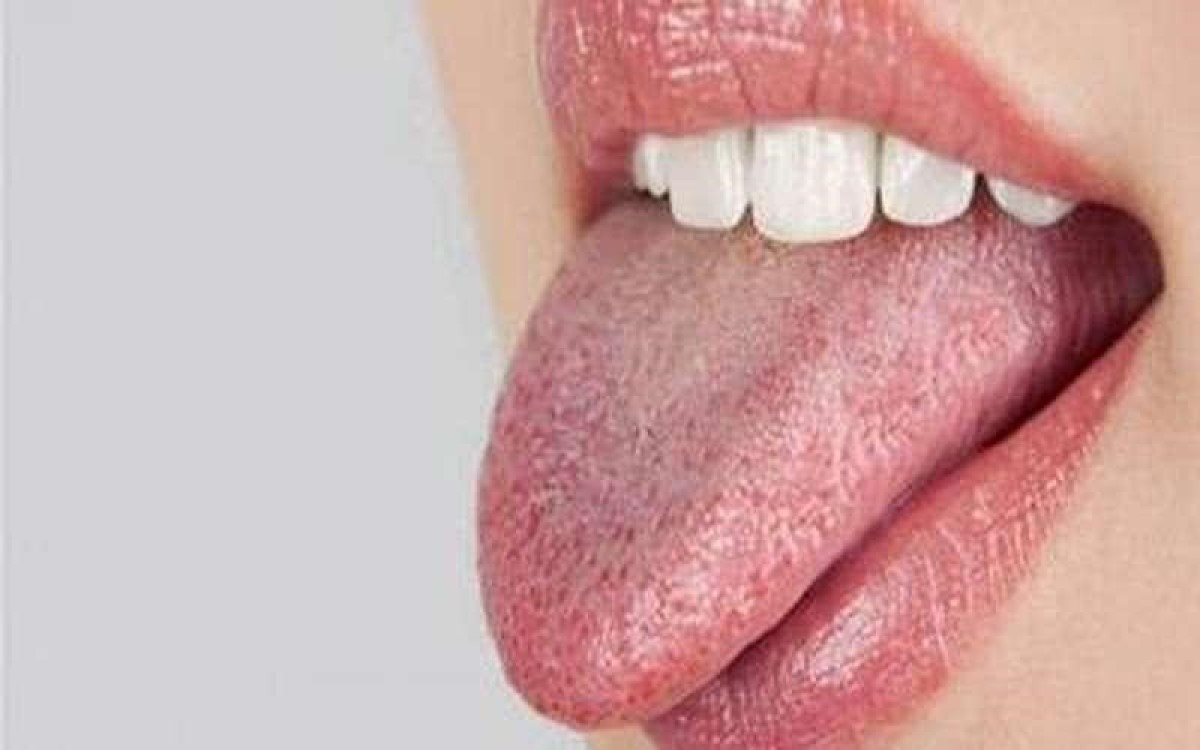 سفید بودن سطح زبان چه هشداری درباره سلامت بدن شما می دهد؟