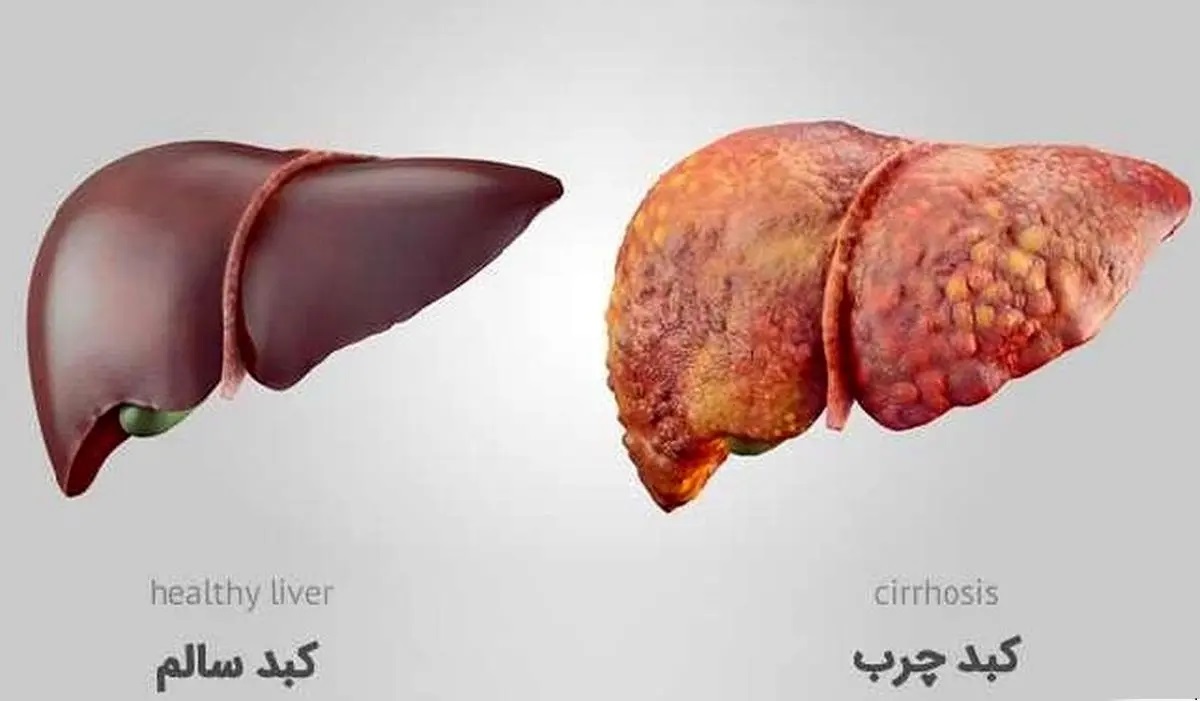 پایان کبد چرب با انتخاب‌های روزمره؛ معجزه تغذیه و سبک زندگی سالم برای سلامت کبد!